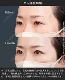 タレ目尻切開 after画像 サムネイル用