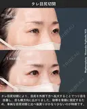 タレ目尻切開 after画像 サムネイル用