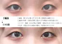目頭切開法 30日後 サムネイル用