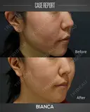 ルメッカ after画像 サムネイル用