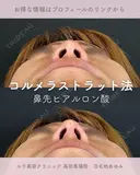 鼻先ヒアルロン酸（コルメラストラット法） before画像 サムネイル用