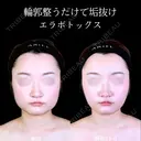 エラボトックス 90日後 サムネイル用
