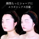 エラボトックス before画像 サムネイル用