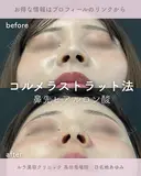 鼻先ヒアルロン酸（コルメラストラット法） before画像 サムネイル用