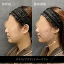 リバー式小顔脂肪吸引 after画像 サムネイル用