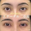 二重埋没（エターナル二重術） before画像 サムネイル用