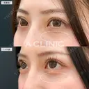【目の下のクマ取り】可愛さ更にアップデートされました！こちら処置前と1ヶ月後の症例です 30日後 サムネイル用