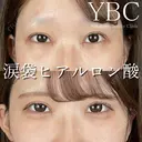 【🍪涙袋ヒアルロン酸🍪】 before画像 サムネイル用