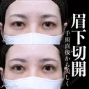 眉下切開 before画像 サムネイル用