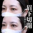 眉下切開 0日後 サムネイル用