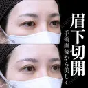 眉下切開 0日後 サムネイル用
