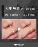 人中短縮（MIX切開） before画像 サムネイル用