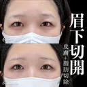 眉下切開/ROOF切除 180日後 サムネイル用