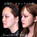 Wing小顔女神脂肪吸引 90日後 サムネイル用