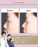 鼻尖形成　軟骨移植　貴族プロテーゼ　鼻柱下降 after画像 サムネイル用