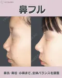 鼻尖形成　軟骨移植　鼻柱下降　小鼻縮小 after画像 サムネイル用