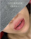 リップアートメイク初回（アトピー既往あり） after画像 サムネイル用