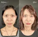 鼻整形－複合－ after画像 サムネイル用