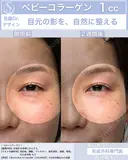 【30代女性】ベビーコラーゲン before画像 サムネイル用
