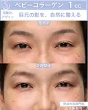 【30代女性】ベビーコラーゲン 14日後 サムネイル用