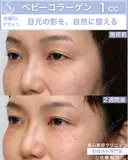【30代女性】ベビーコラーゲン 14日後 サムネイル用