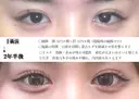 目頭切開法 before画像 サムネイル用
