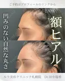 額ヒアルロン酸注入 after画像 サムネイル用