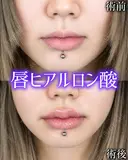 Cカールリップ before画像 サムネイル用