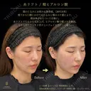 糸リフト・頬ヒアルロン酸 before画像 サムネイル用