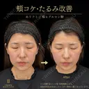 糸リフト・頬ヒアルロン酸 0日後 サムネイル用
