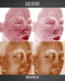 ルメッカ before画像 サムネイル用