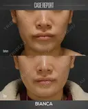ルメッカ after画像 サムネイル用