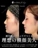 鼻整形×目元整形 after画像 サムネイル用