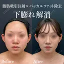 ベイザー併用アキーセル脂肪吸引(ホホ・ジョールファット・あご下)＋バッカルファット除去 after画像 サムネイル用