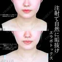 エラボトックス before画像 サムネイル用