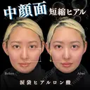 涙袋ヒアルロン酸 0日後 サムネイル用