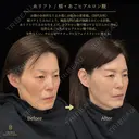 糸リフト・頬ヒアルロン酸・あごヒアルロン酸 before画像 サムネイル用