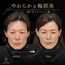 糸リフト・頬ヒアルロン酸・あごヒアルロン酸 31日後 サムネイル用