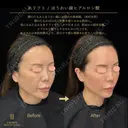 糸リフト・ほうれい線ヒアルロン酸 before画像 サムネイル用