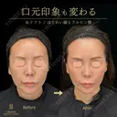 糸リフト・ほうれい線ヒアルロン酸 31日後 サムネイル用