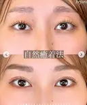 エターナル二重術 30日後 サムネイル用