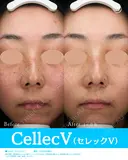 セレックV after画像 サムネイル用