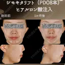 糸リフト、ヒアルロン酸注入 before画像 サムネイル用