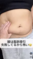 シークレット脂肪吸引お腹 before画像 サムネイル用