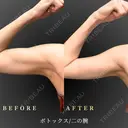 二の腕ボトックス before画像 サムネイル用