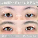 【形成外科専門医在籍】✨施術件数400件以上⭐選べる目元施術｜二重切開・目頭・目尻切開など｜麻酔代込み🌼 30日後 サムネイル用