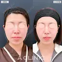 【1day小顔＋エラのボトックス注射】フェイスラインのボリューム感がスッキリ！こちら処置前と2ヶ月半後の症例です 75日後 サムネイル用