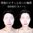 頬・顎下脂肪吸引/バッカルファット/ジョールファット/糸リフト/エラボトックス/顎ヒアルロン酸 180日後 サムネイル用