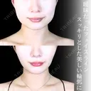 頬・顎下脂肪吸引/バッカルファット/ジョールファット/糸リフト/エラボトックス/顎ヒアルロン酸 before画像 サムネイル用