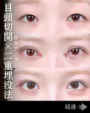 MD式目頭切開/二重埋没法 90日後 サムネイル用
